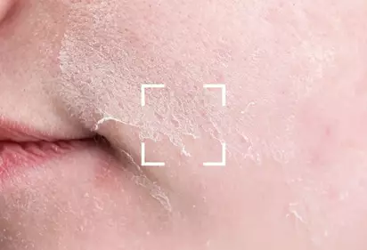 la perte d'eau transepidermique (T.E.W.L.)