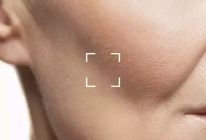 Perte de Volume Facial