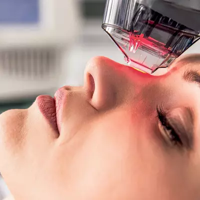non ablative laser