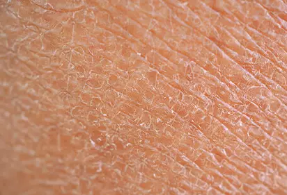 Comment garder votre peau hydratee pendant les mois d'hiver