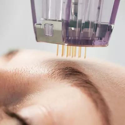 IPL Laser