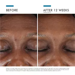 Before-after image: results visible after 12 weeks
