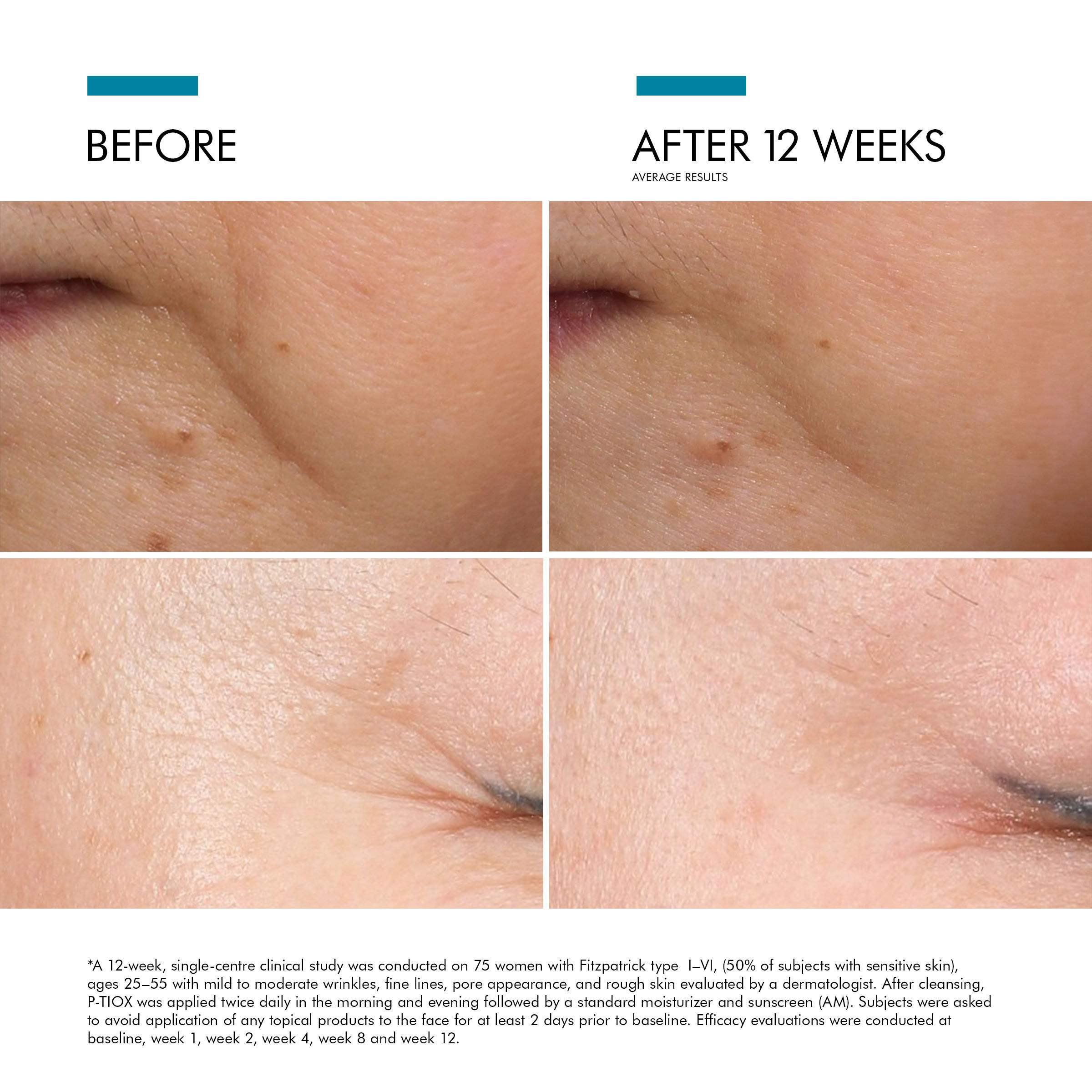 Proven efficiency on finelines and wrinkles after 12 weeks