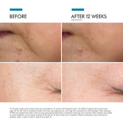 Proven efficiency on finelines and wrinkles after 12 weeks