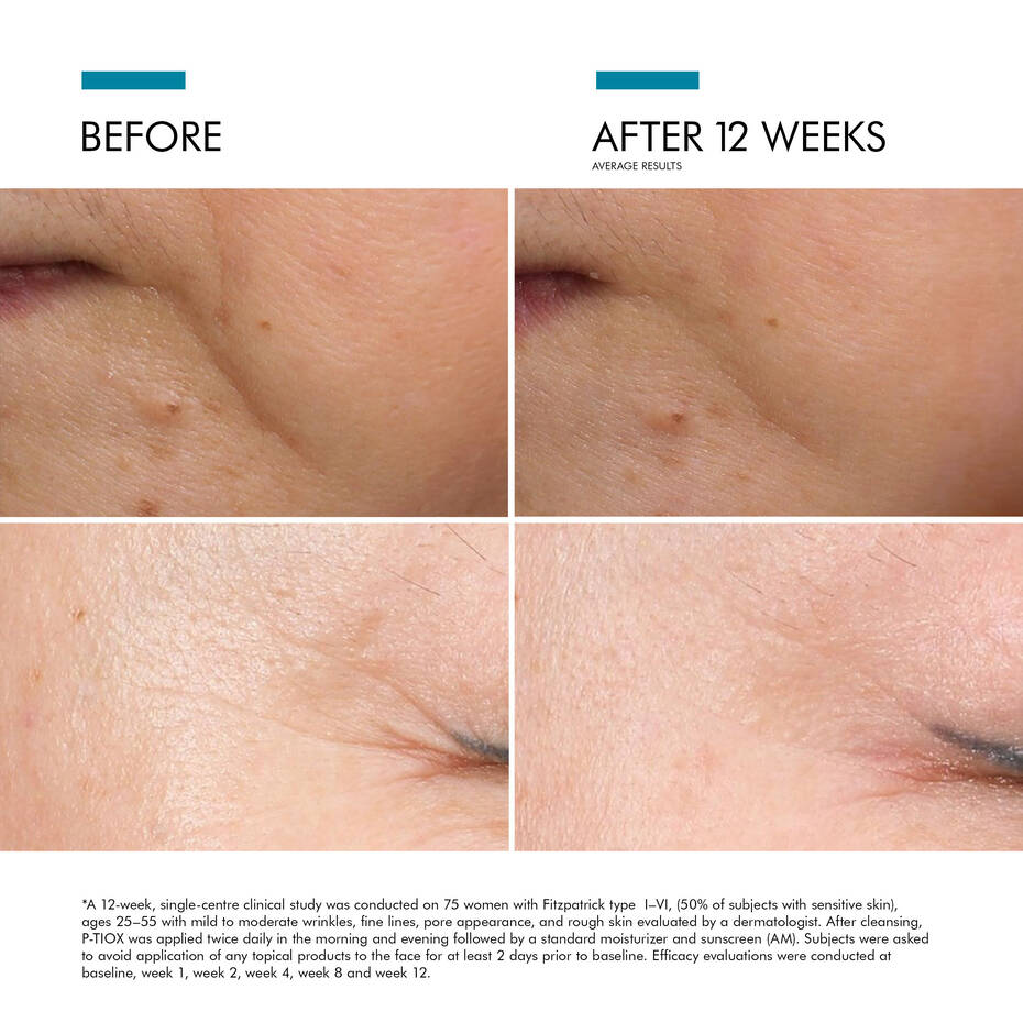 P-TIOX Anti-Wrinkle Serum - Fine Lines - SkinCeuticals CA
