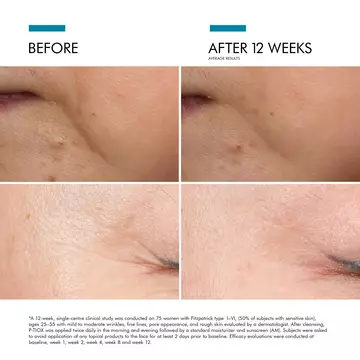 Proven efficiency on finelines and wrinkles after 12 weeks
