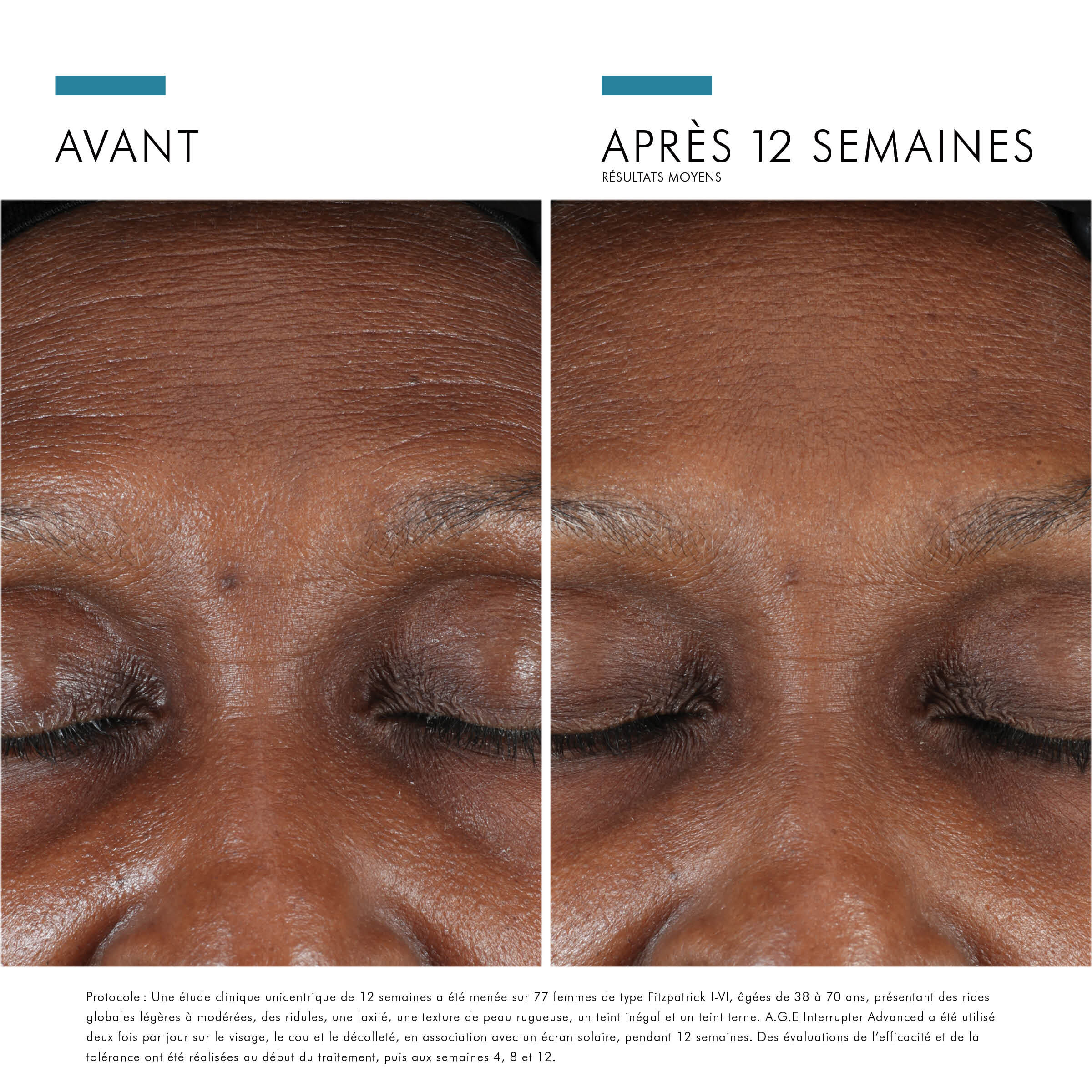 Before-after image: results visible after 12 weeks