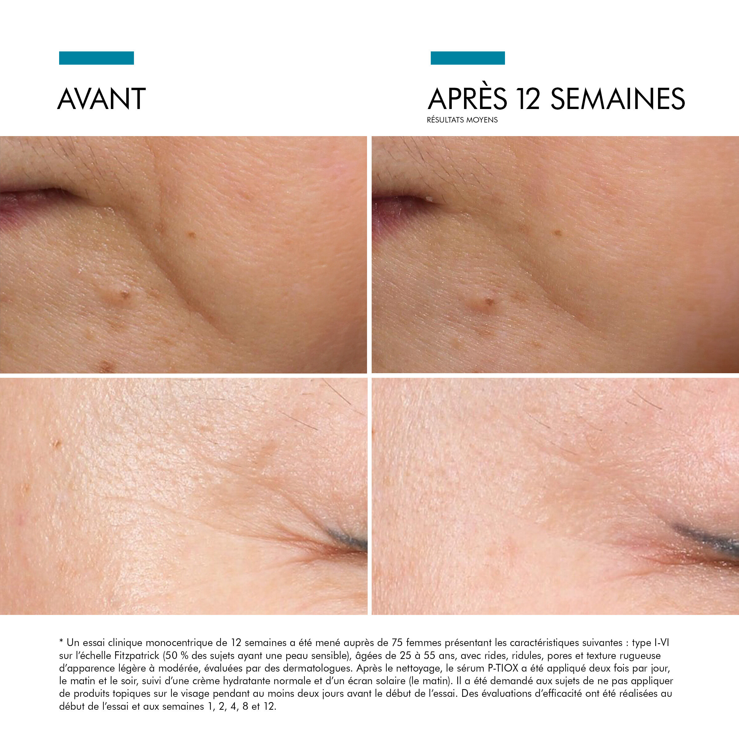 Proven efficiency on finelines and wrinkles after 12 weeks