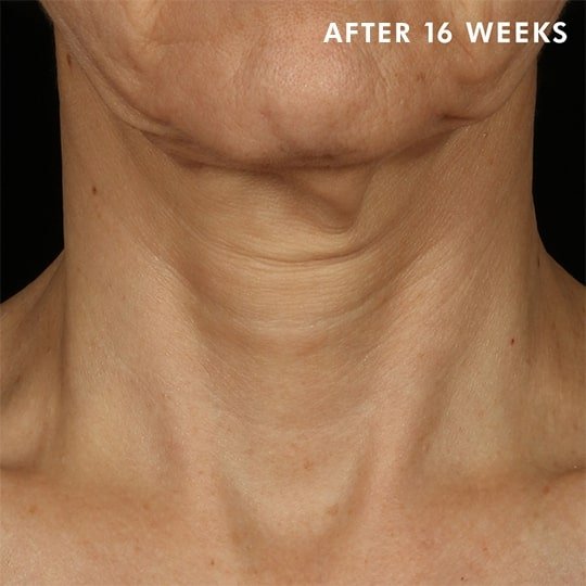 Skinceuticals Canada After